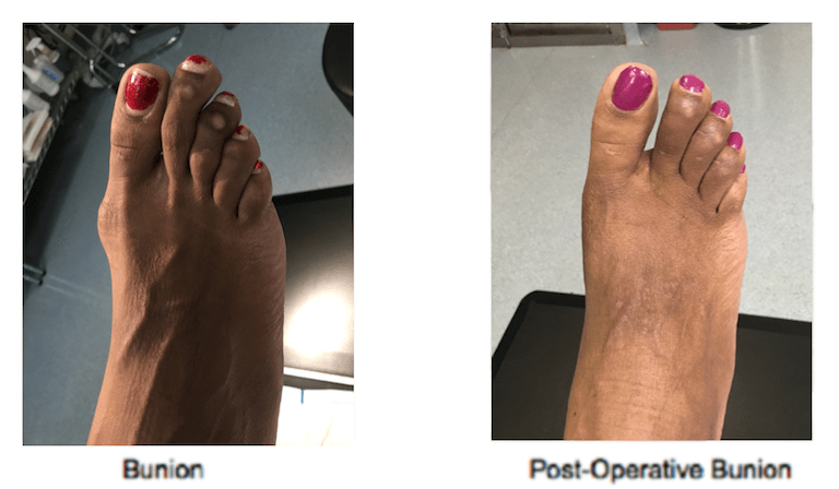 Bunion Surgery