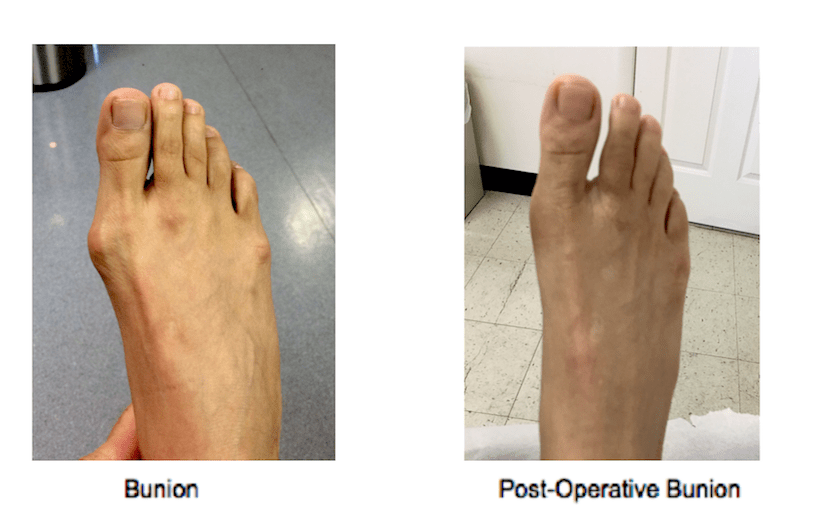 Bunion Surgery NY, NY