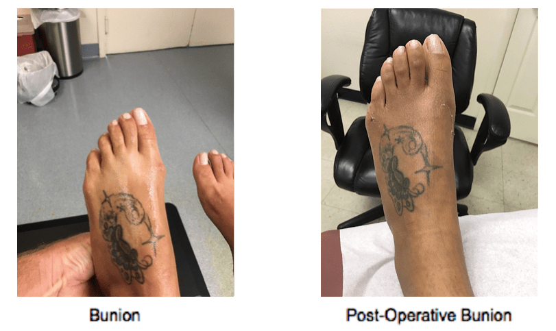 Bunion-Surgery-NYC