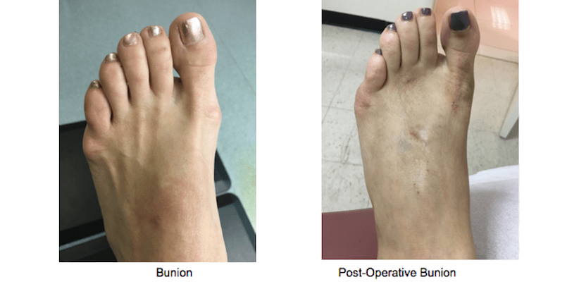 Bunion Surgery - NYC Podiatrist