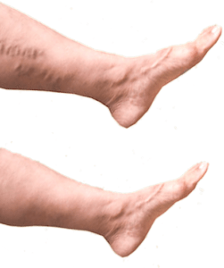 Swollen Feet, Ankles, Legs, and Edema