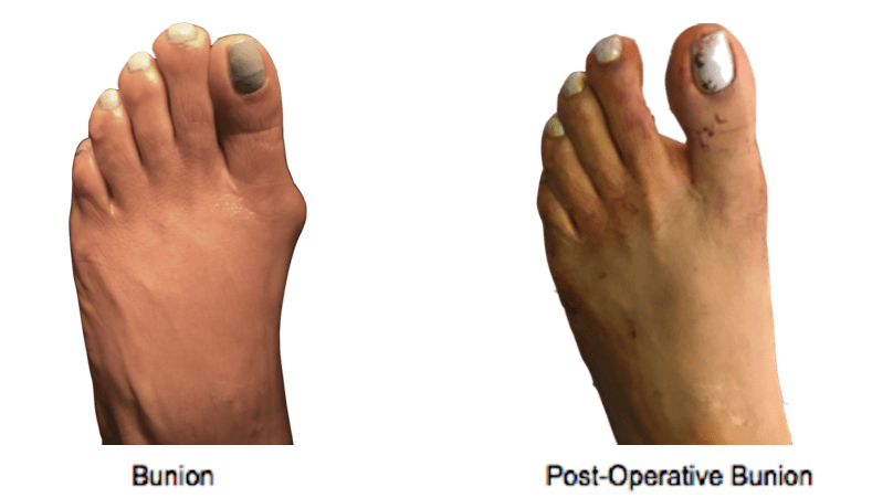 Bunion-Surgery-NYC