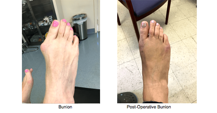 Bunion Surgery Before And After