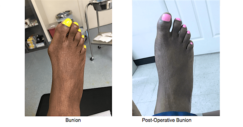 Bunion Surgery, New York, NY