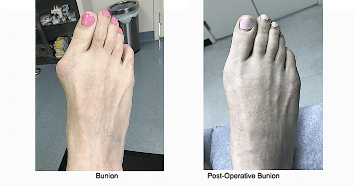 Bunion Surgery