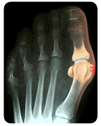 X-Ray of Foot Showing Big Toe Bunion Deformity