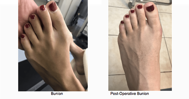 Bunion Surgery NYC