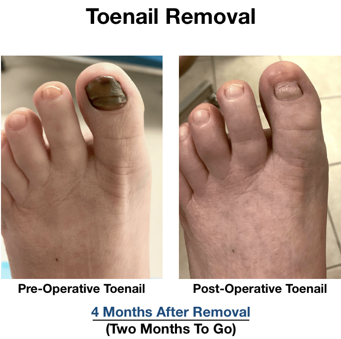 Toenail Removal NYC