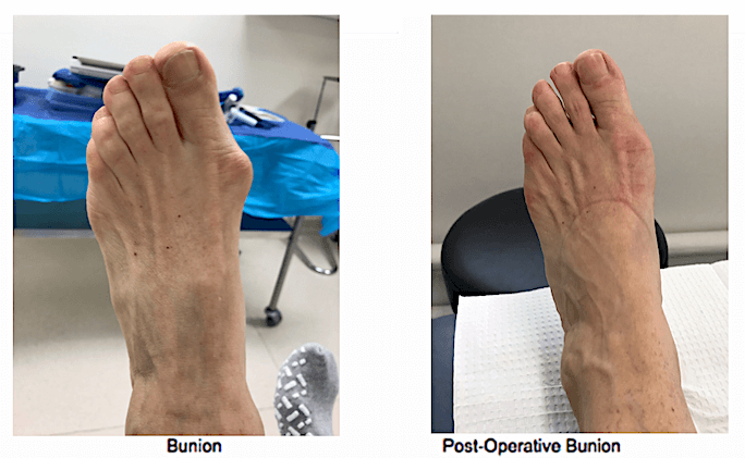 Bunion Surgery