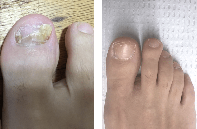 Toe Nail Removal