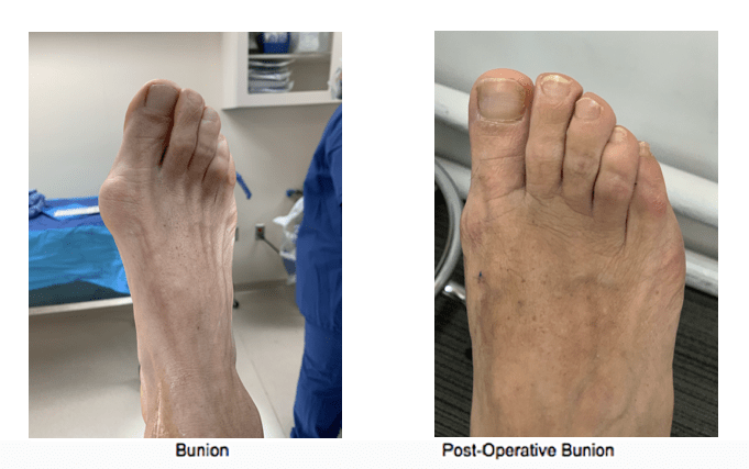 Bunions