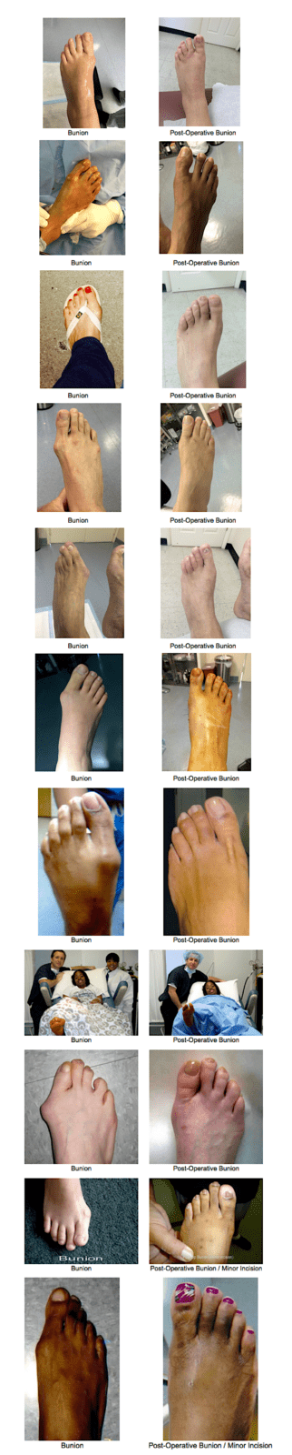 Bunion-Surgery-NYC-Podiatrist-New-York