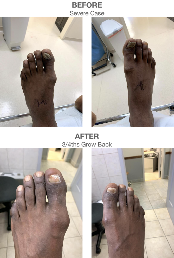 Toenail Removal - Fungus Removal Specialist NYC