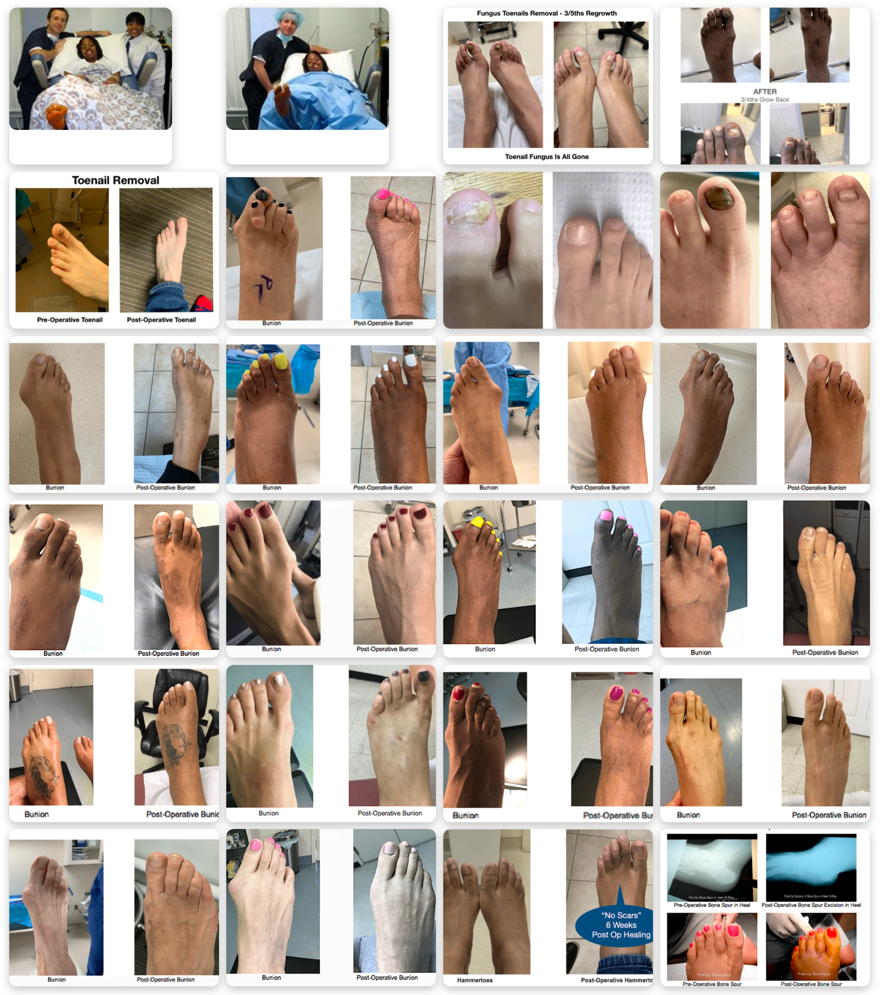 Before & afters of foot surgeries: bunions, hammertoes, toenail removals, & post-op results